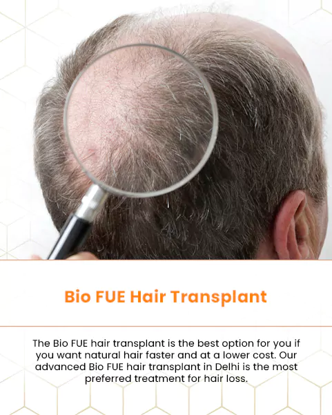 Fue Hair Transplant - Surgeon, Clinic, Process and Cost in South Delhi