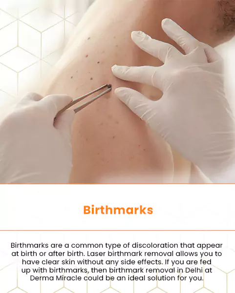 birthmarks