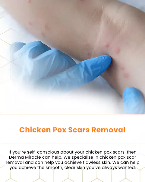 chicken pox scars removal