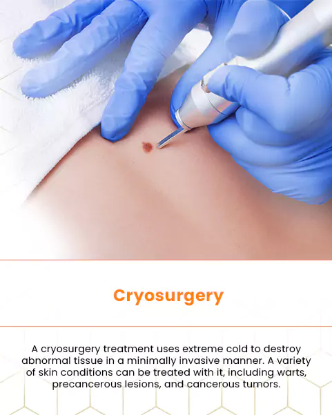 cryosurgery