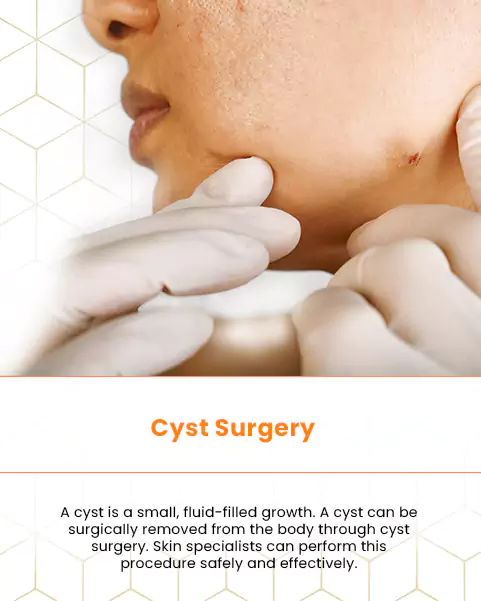 cyst surgery