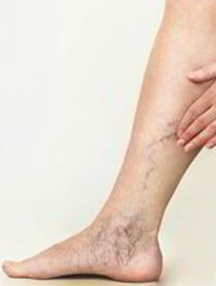 leg veins treatment