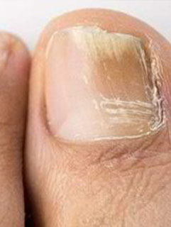 nail infections