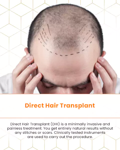 DHI Hair Transplantation  Hair Transplant Turkey Istanbul