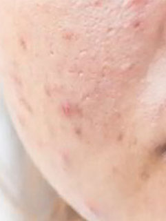 acne scar surgery