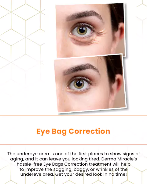 eye bag correction