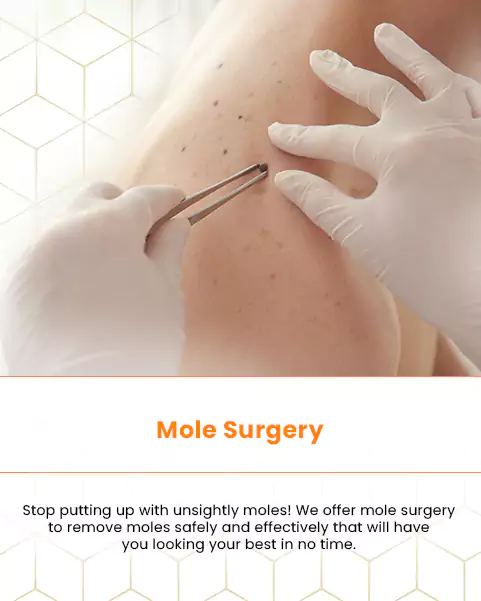 mole surgery
