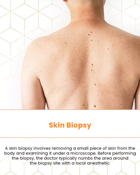 skin biopsy