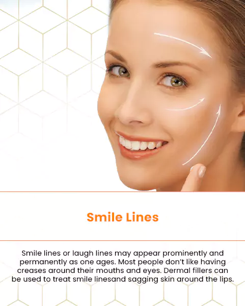 smile lines