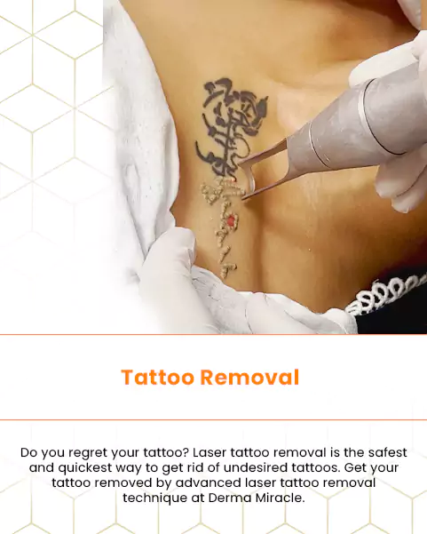 PicoWay® Tattoo Removal - Little Rock, AR - Dr. Suzanne Yee