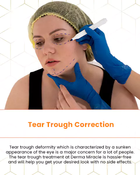 tear trough correction