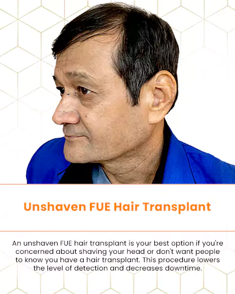 unshaven fue hair transplant