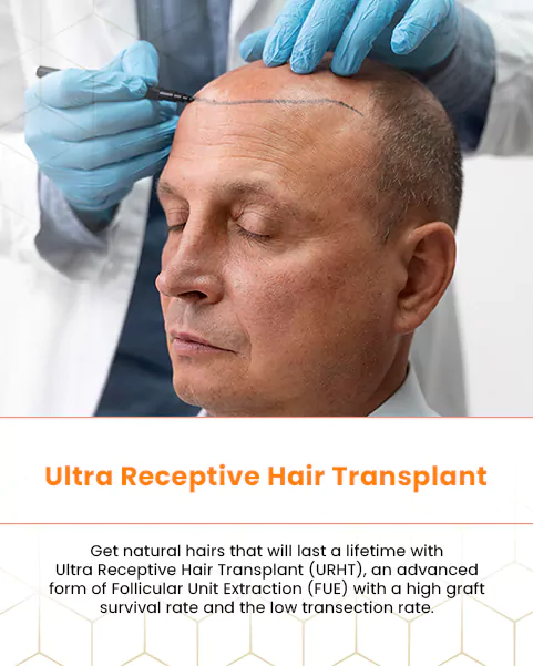 ultra receptive hair transplant