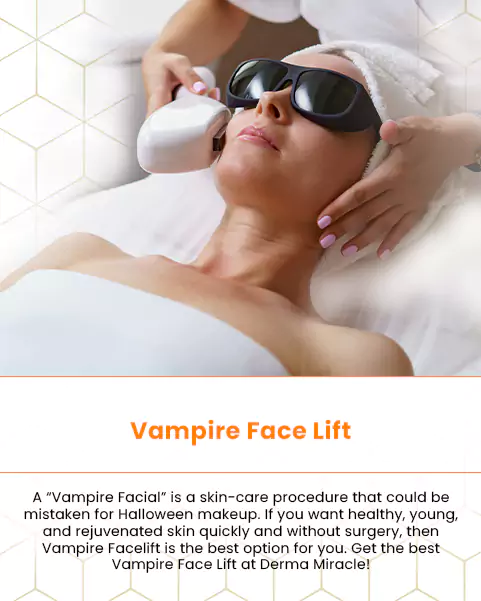 vampire face lift