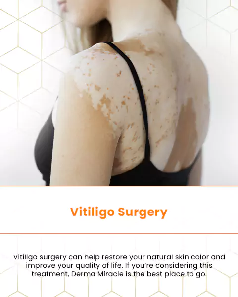 vitiligo surgery
